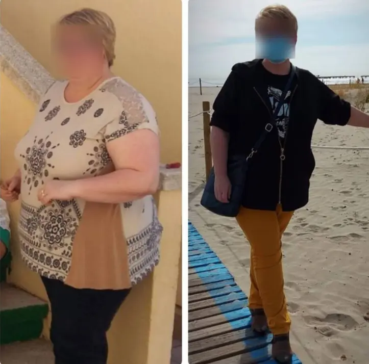 Pérdida de peso con cirugía bariátrica en Castellón de la Plana - Transformación antes y después